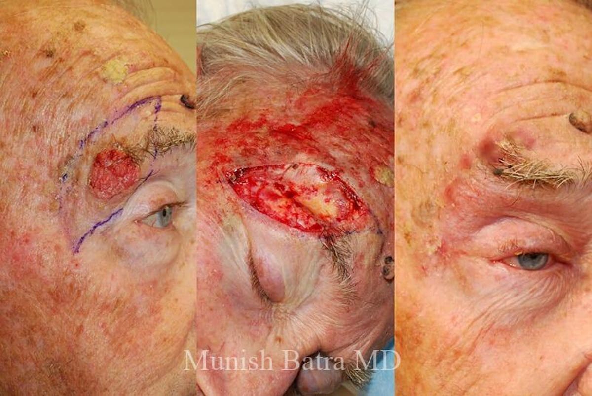 Skin Cancer Before & After Gallery - Patient 552582 - Image 1