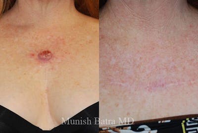 Skin Cancer Before & After Gallery - Patient 258221 - Image 1