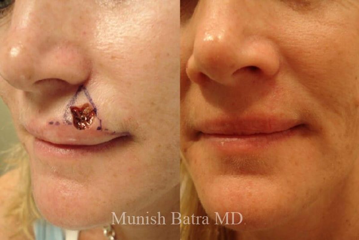 Skin Cancer Before & After Gallery - Patient 868425 - Image 1