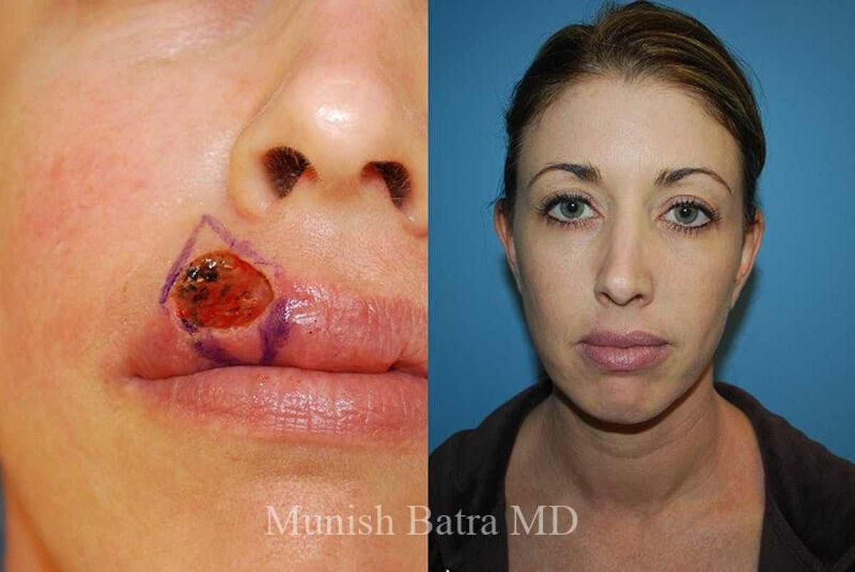 Skin Cancer Before & After Gallery - Patient 144007 - Image 1