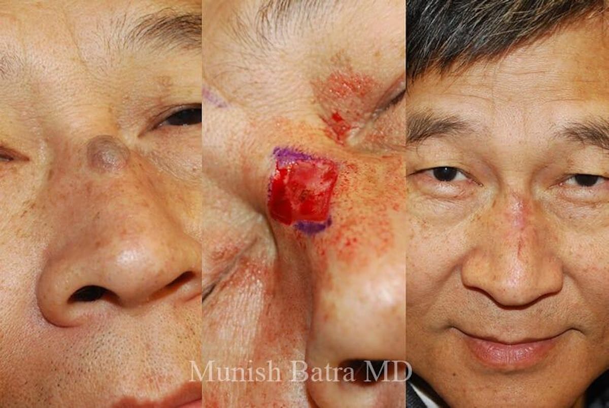 Skin Cancer Before & After Gallery - Patient 179943 - Image 1