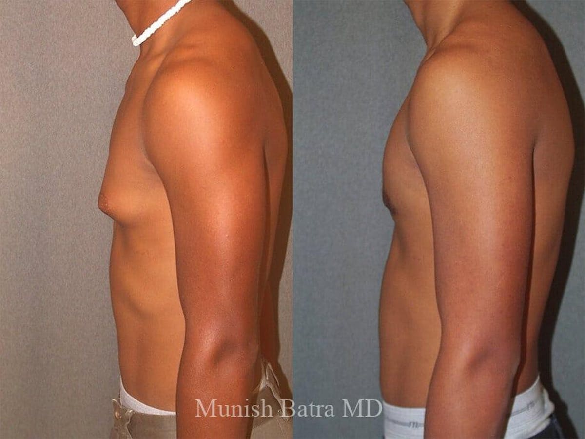 Gynecomastia Before & After Gallery - Patient 280790 - Image 1