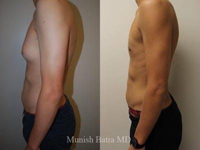 Gynecomastia Before & After Gallery - Patient 409153 - Image 1