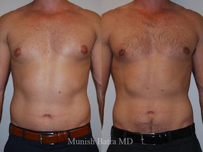 Gynecomastia Before & After Gallery - Patient 234719 - Image 1