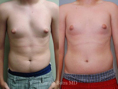 Gynecomastia Before & After Gallery - Patient 305916 - Image 1
