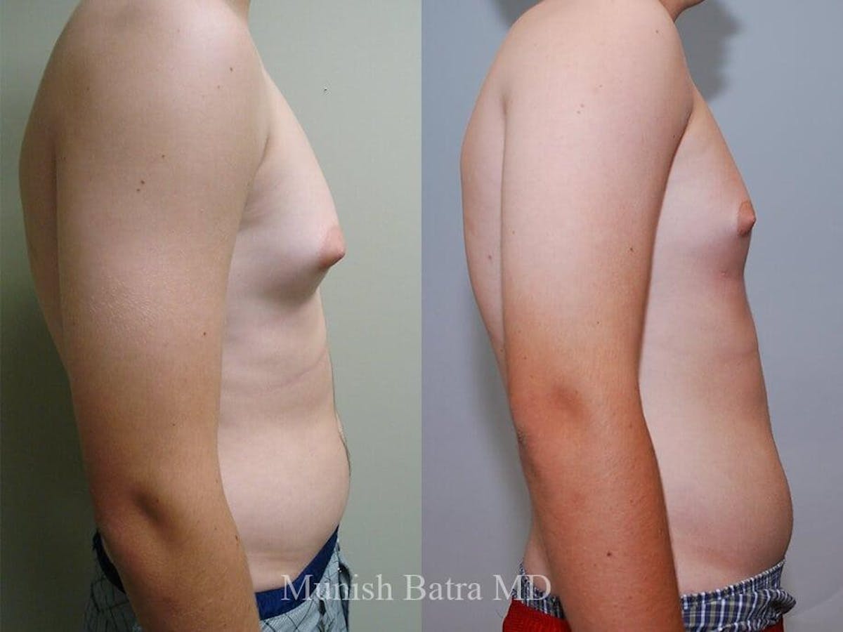 Gynecomastia Before & After Gallery - Patient 305916 - Image 2