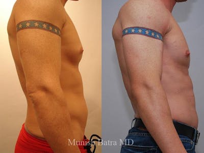 Gynecomastia Before & After Gallery - Patient 246128 - Image 1