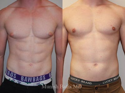 Gynecomastia Before & After Gallery - Patient 231269 - Image 1