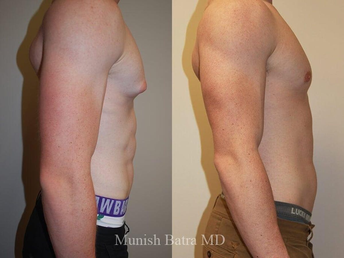 Gynecomastia Before & After Gallery - Patient 231269 - Image 2