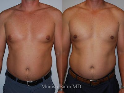 Gynecomastia Before & After Gallery - Patient 376346 - Image 1