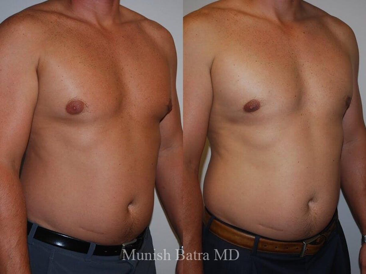 Gynecomastia Before & After Gallery - Patient 376346 - Image 2