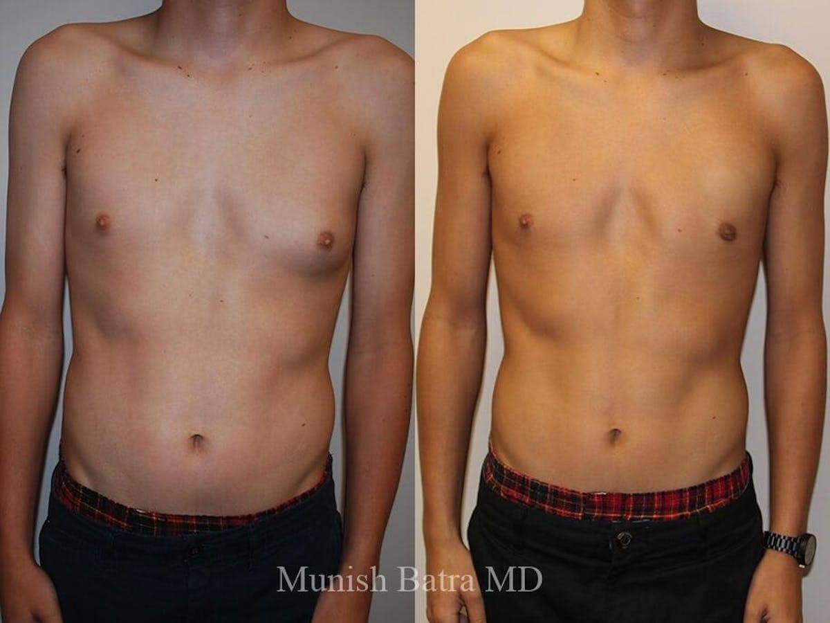 Gynecomastia Before & After Gallery - Patient 328494 - Image 1