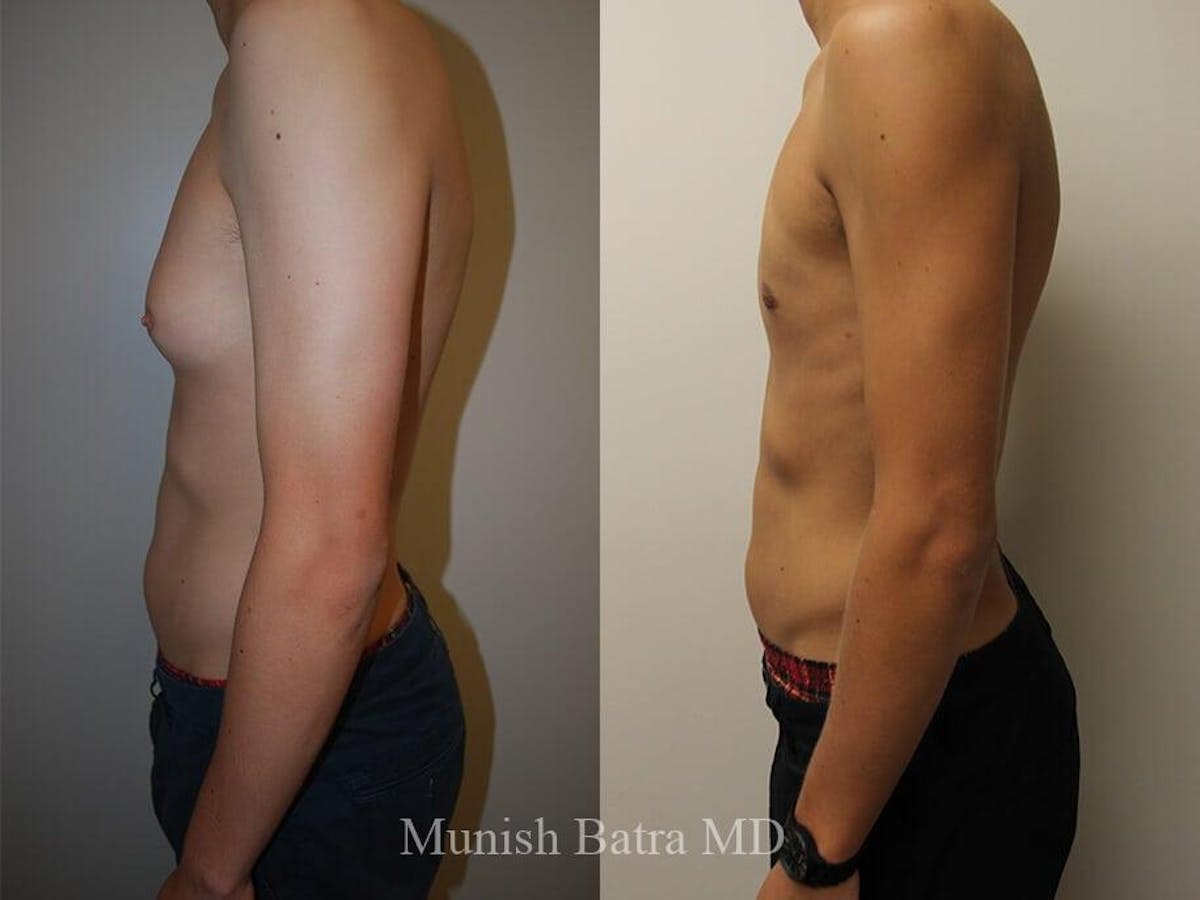 Gynecomastia Before & After Gallery - Patient 328494 - Image 2
