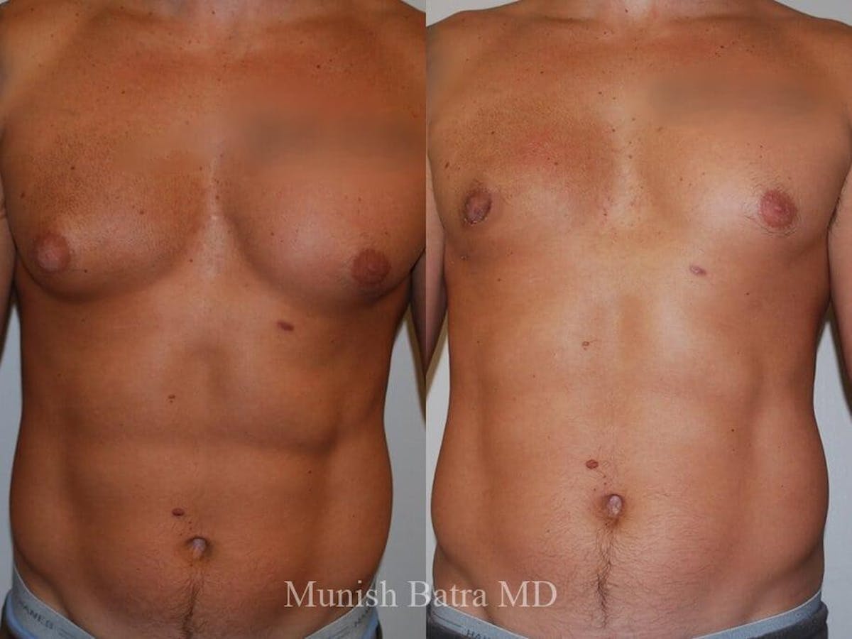 Gynecomastia Before & After Gallery - Patient 292826 - Image 1