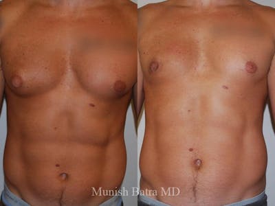 Gynecomastia Before & After Gallery - Patient 292826 - Image 1