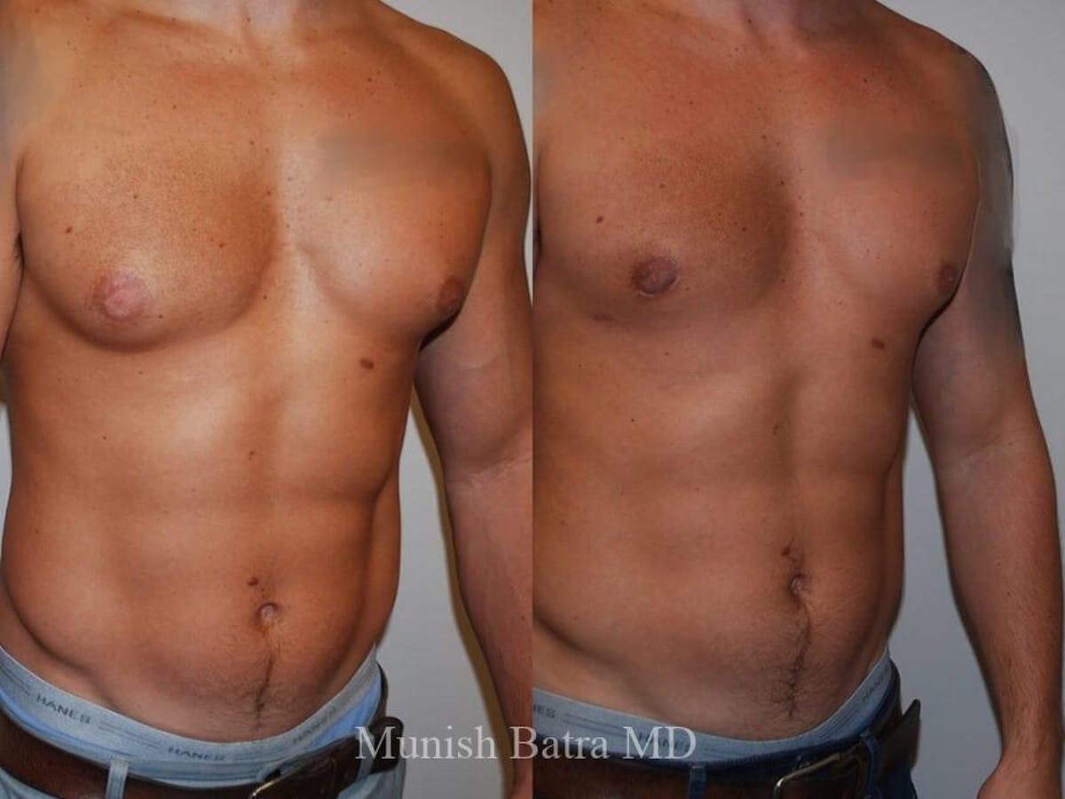 Gynecomastia Before & After Gallery - Patient 292826 - Image 2