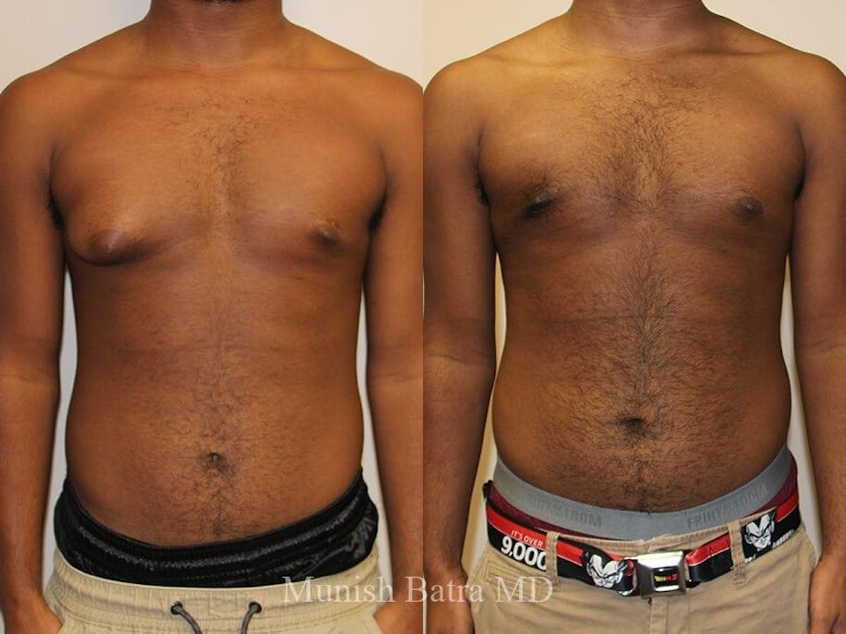 Gynecomastia Before & After Gallery - Patient 167165 - Image 1
