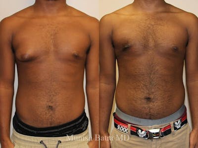 Gynecomastia Before & After Gallery - Patient 167165 - Image 1