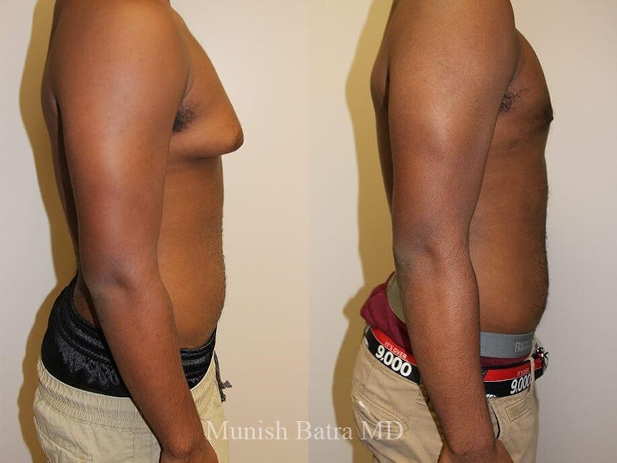 Gynecomastia Before & After Gallery - Patient 167165 - Image 2