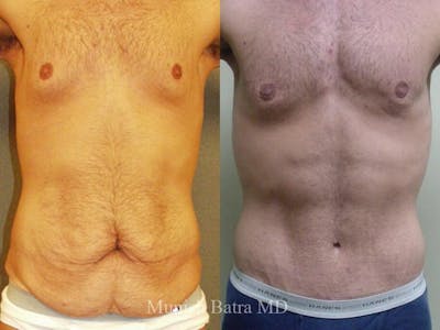 Male Abdominoplasty Before & After Gallery - Patient 263890 - Image 1