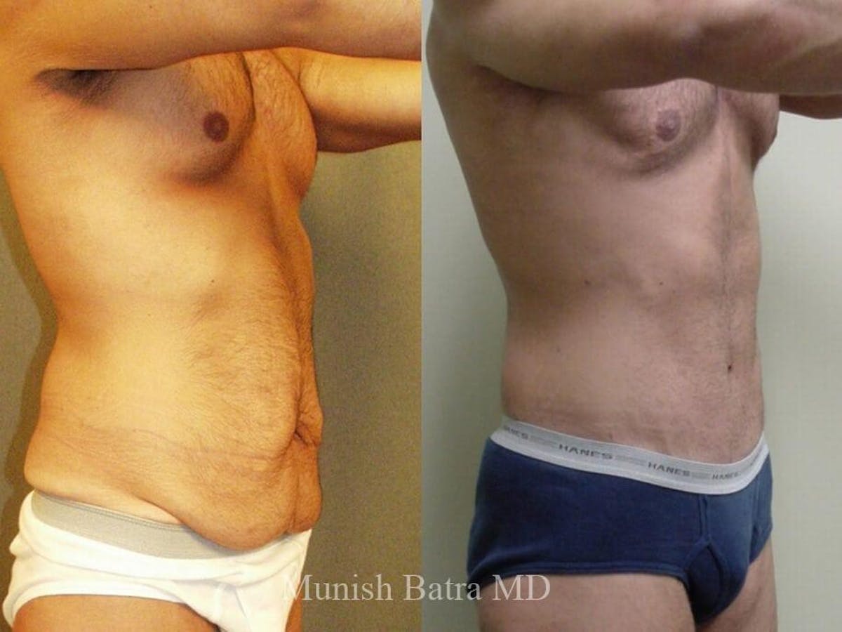 Male Abdominoplasty Before & After Gallery - Patient 263890 - Image 2