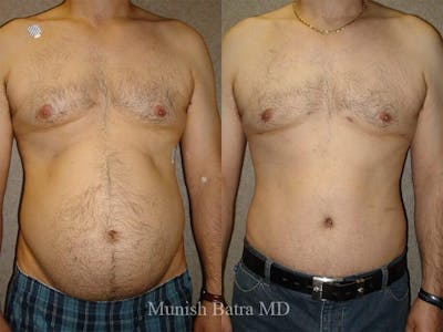 Male Abdominoplasty Before & After Gallery - Patient 424130 - Image 1