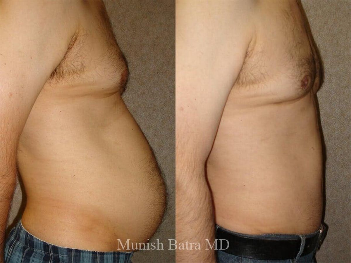Male Abdominoplasty Before & After Gallery - Patient 424130 - Image 2