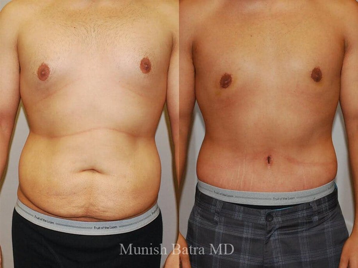 Male Abdominoplasty Before & After Gallery - Patient 177743 - Image 1
