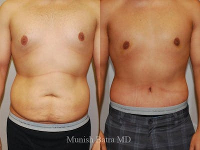 Male Abdominoplasty Before & After Gallery - Patient 177743 - Image 1