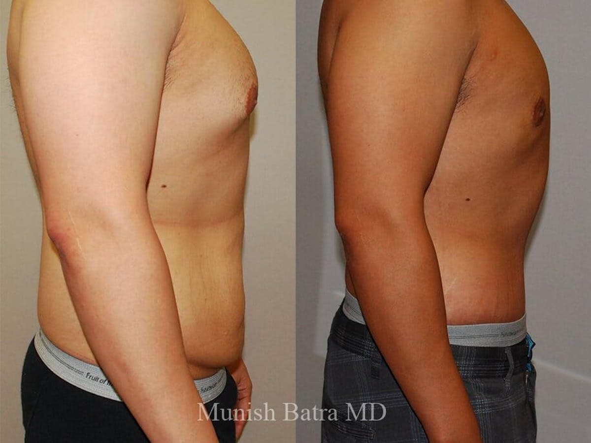 Male Abdominoplasty Before & After Gallery - Patient 177743 - Image 2
