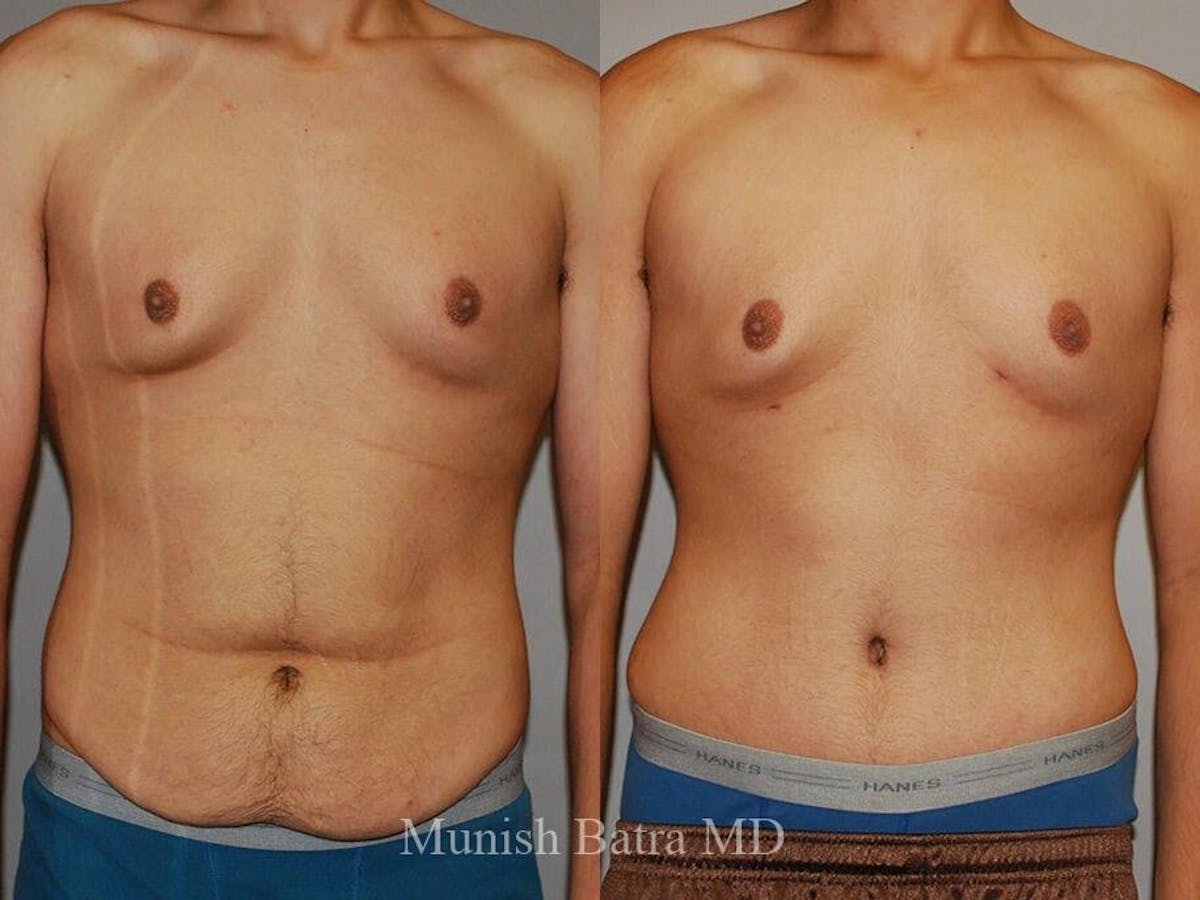 Male Abdominoplasty Before & After Gallery - Patient 126304 - Image 1