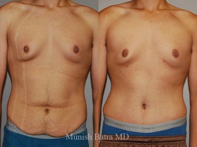 Male Abdominoplasty Before & After Gallery - Patient 126304 - Image 1
