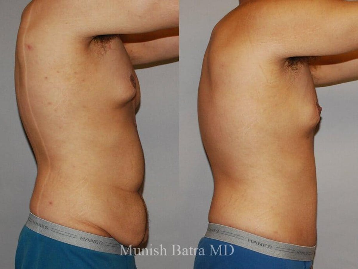 Male Abdominoplasty Before & After Gallery - Patient 126304 - Image 2