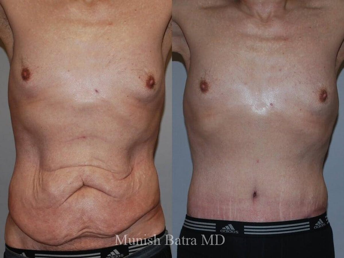 Male Abdominoplasty Before & After Gallery - Patient 134455 - Image 1