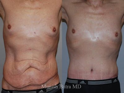 Male Abdominoplasty Before & After Gallery - Patient 134455 - Image 1