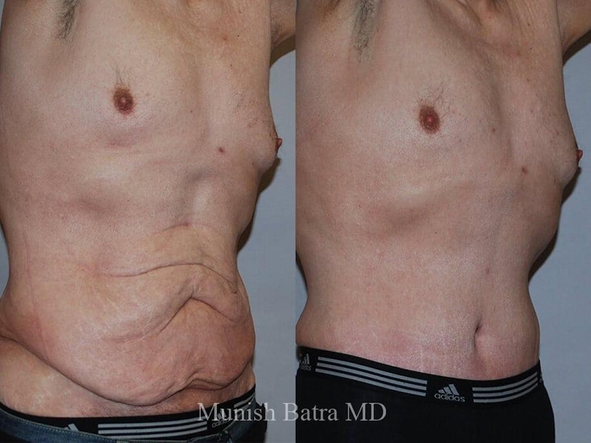 Male Abdominoplasty Before & After Gallery - Patient 134455 - Image 2