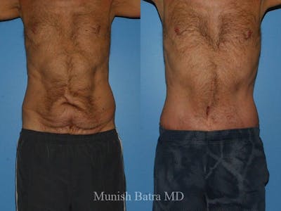 Male Abdominoplasty Before & After Gallery - Patient 746934 - Image 1