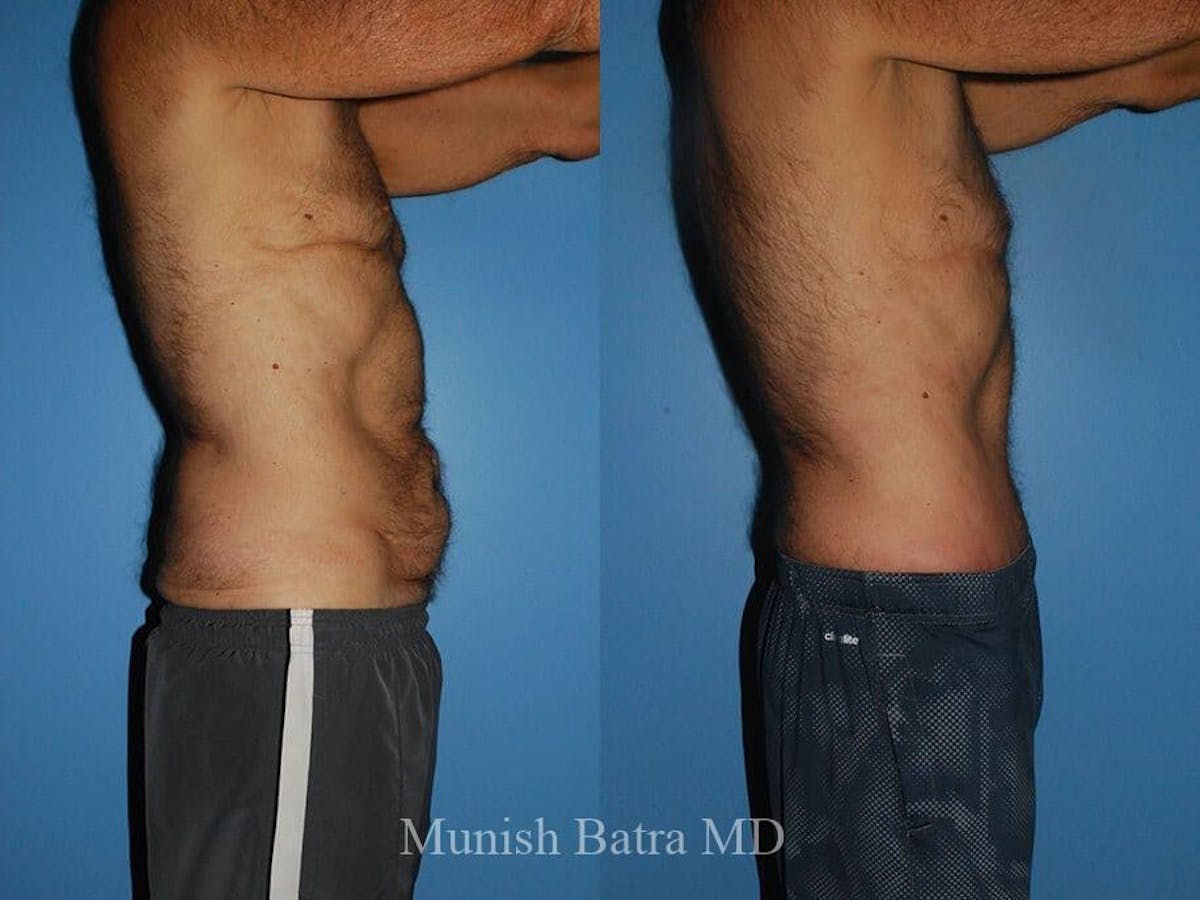 Male Abdominoplasty Before & After Gallery - Patient 746934 - Image 2