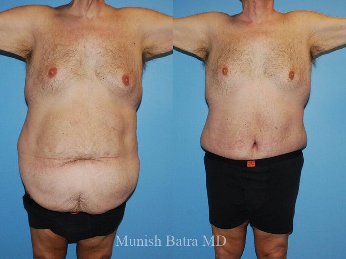 Male Abdominoplasty Before & After Gallery - Patient 184631 - Image 1