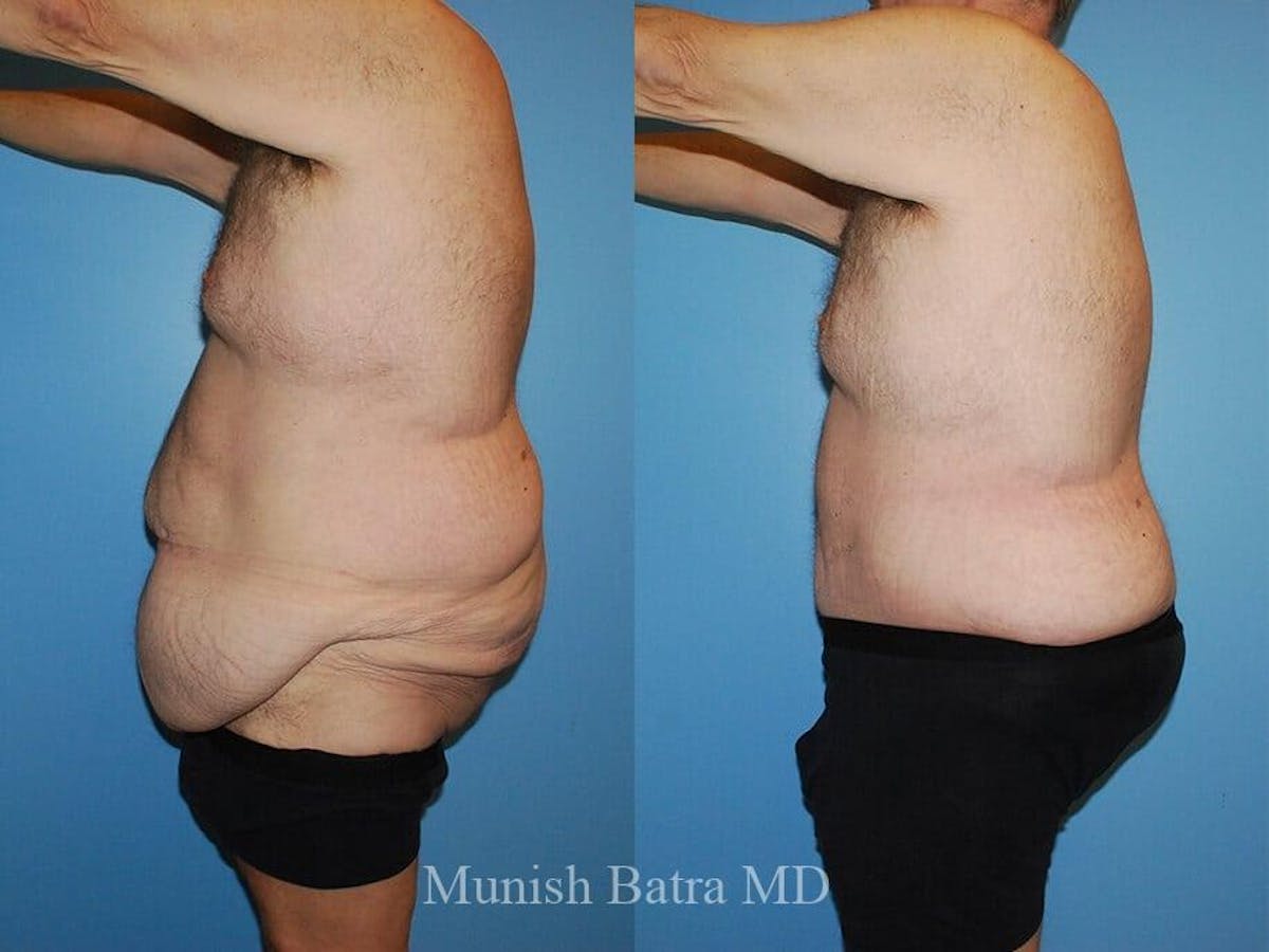 Male Abdominoplasty Before & After Gallery - Patient 184631 - Image 2