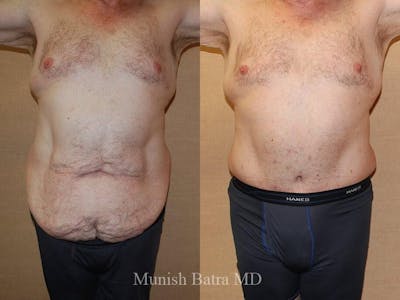Male Abdominoplasty Before & After Gallery - Patient 797924 - Image 1