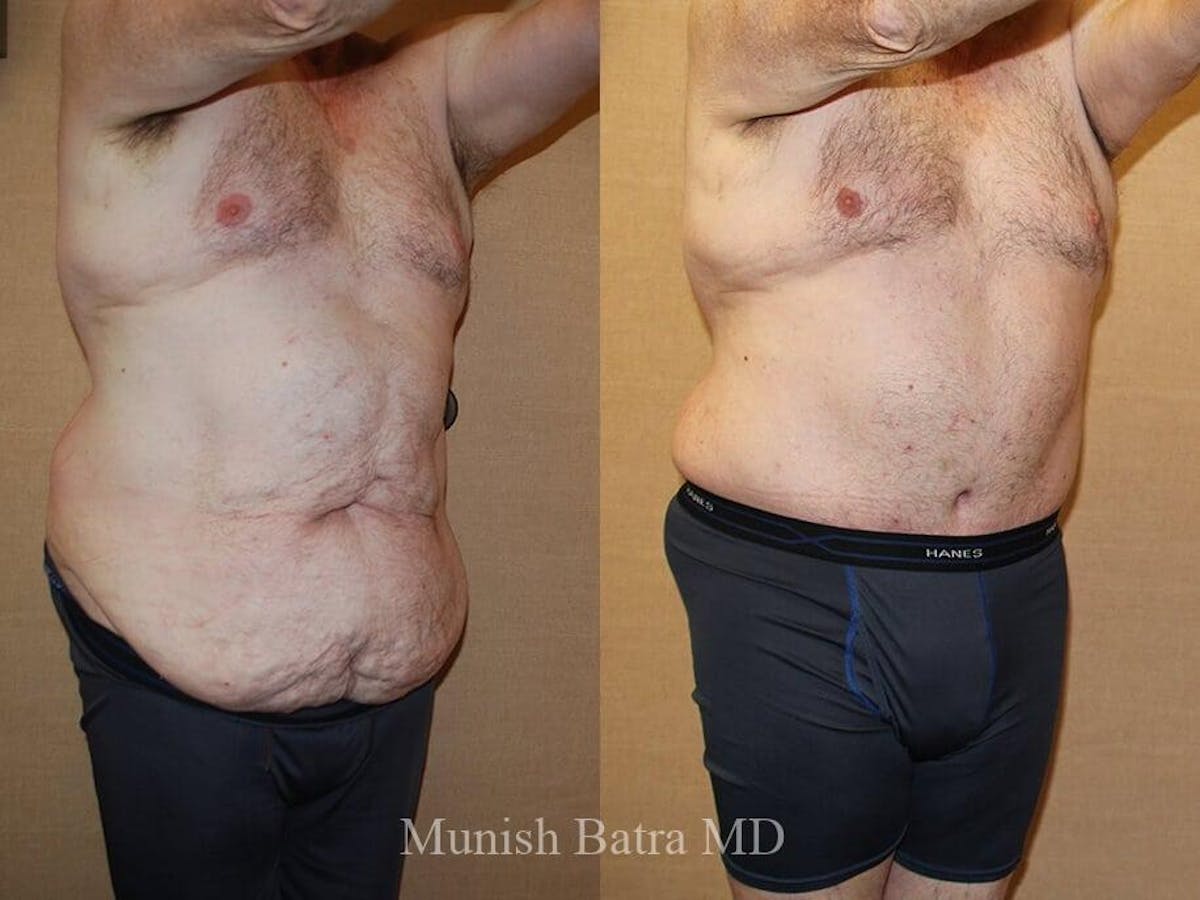 Male Abdominoplasty Before & After Gallery - Patient 797924 - Image 2