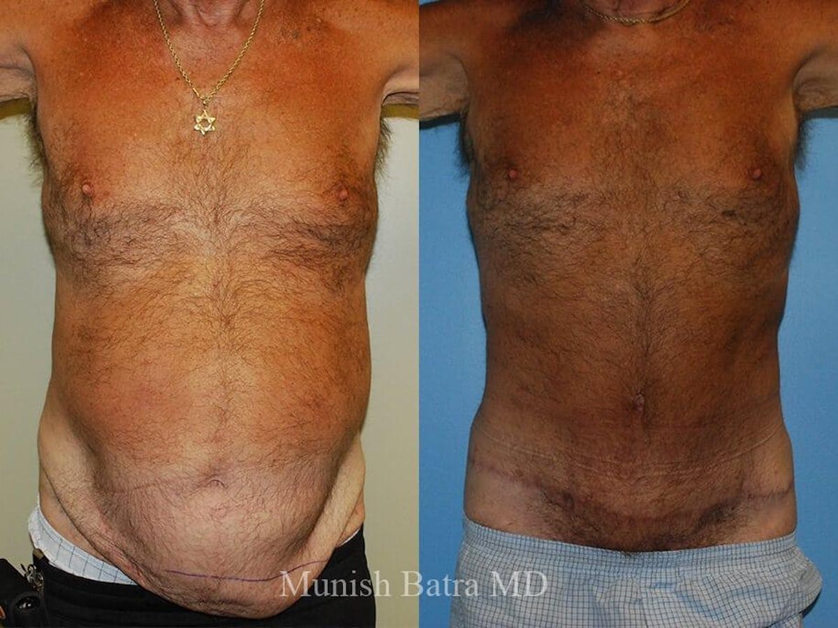 Male Abdominoplasty Before & After Gallery - Patient 213763 - Image 1