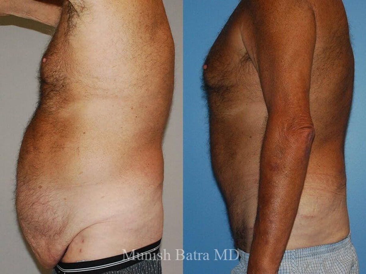 Male Abdominoplasty Before & After Gallery - Patient 213763 - Image 2