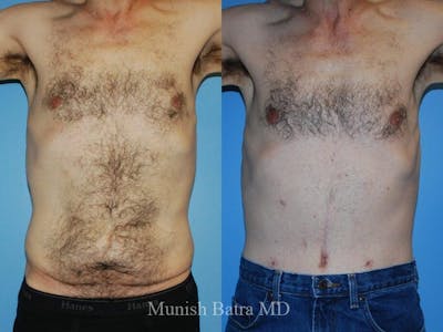 Male Abdominoplasty Before & After Gallery - Patient 424441 - Image 1