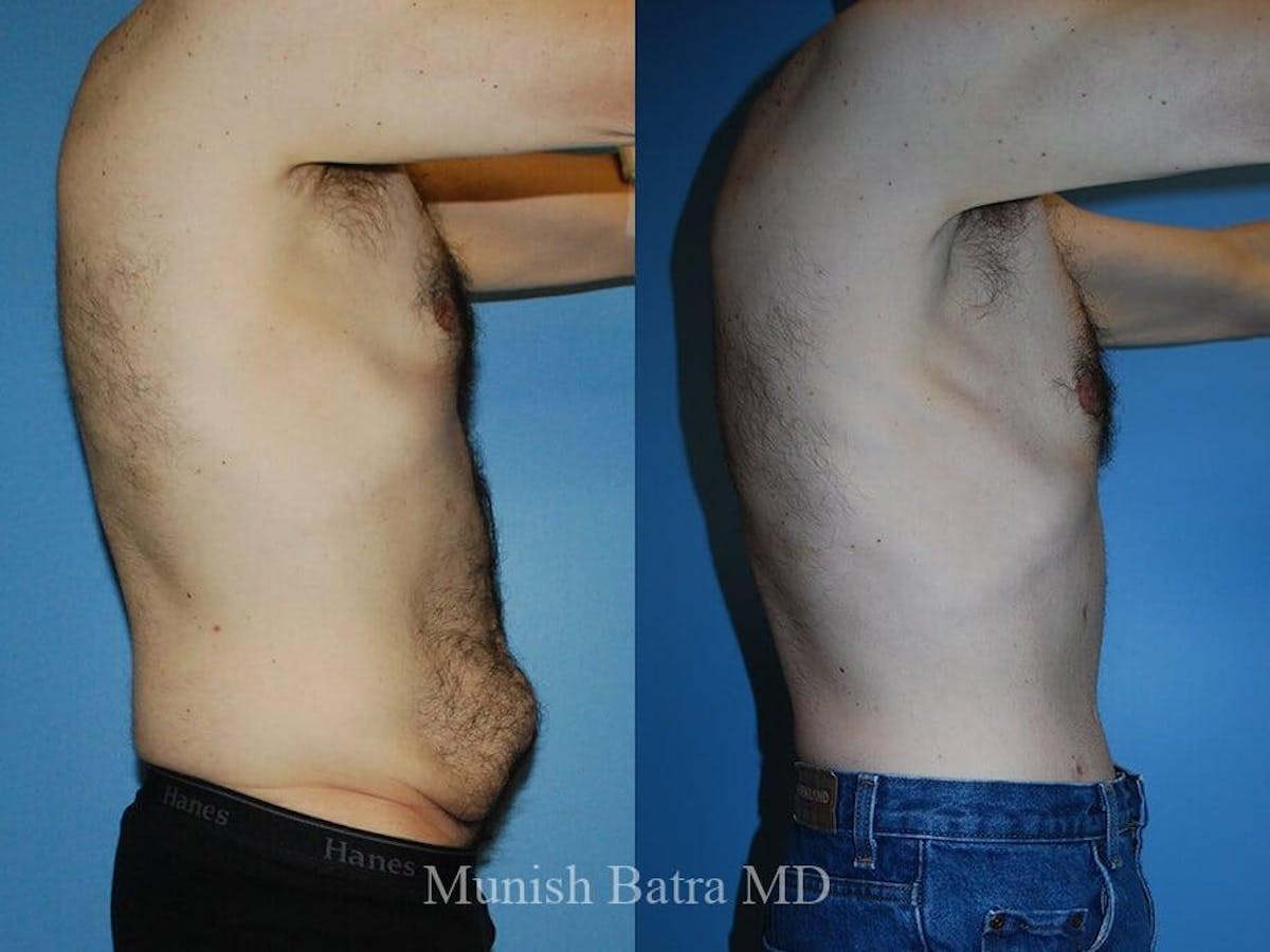 Male Abdominoplasty Before & After Gallery - Patient 424441 - Image 2