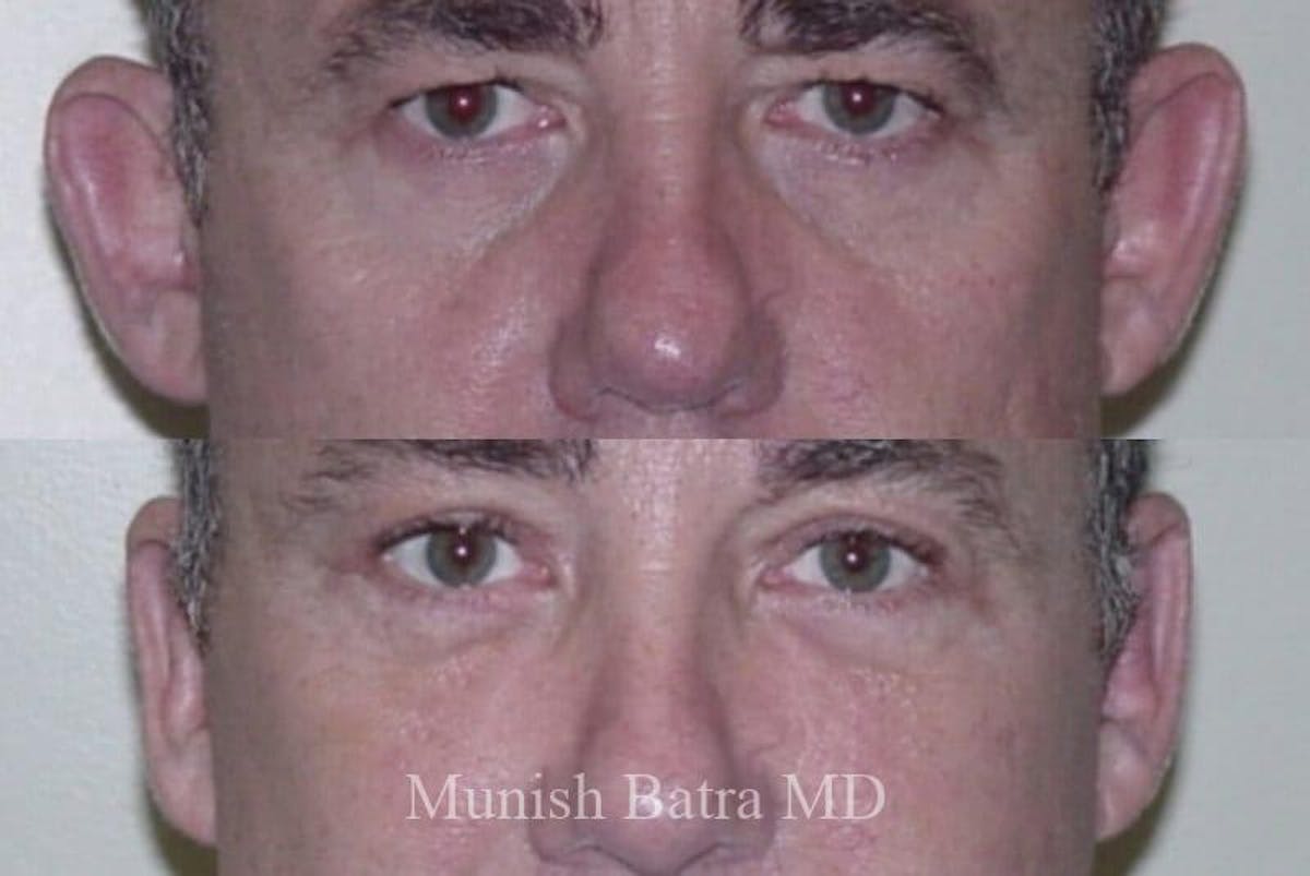 Male Ear Sugery Before & After Gallery - Patient 912896 - Image 1