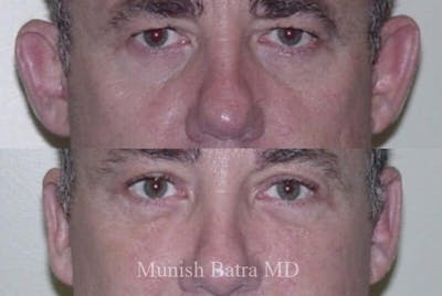 Male Ear Sugery Before & After Gallery - Patient 912896 - Image 1