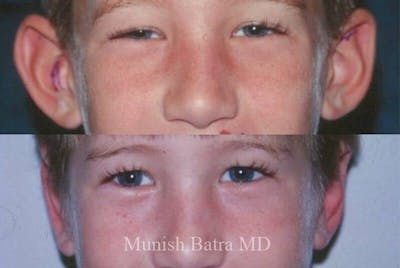 Male Ear Sugery Before & After Gallery - Patient 288775 - Image 1