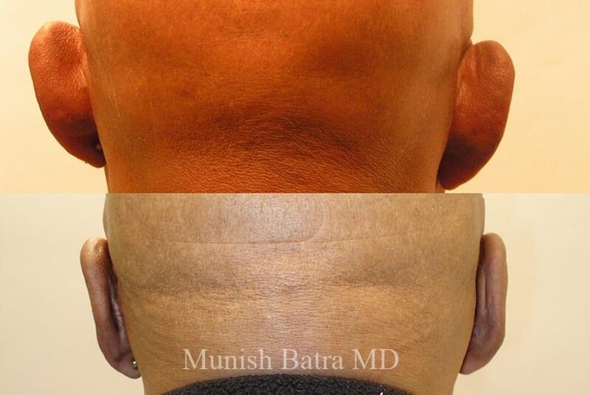 Male Ear Sugery Before & After Gallery - Patient 266876 - Image 1